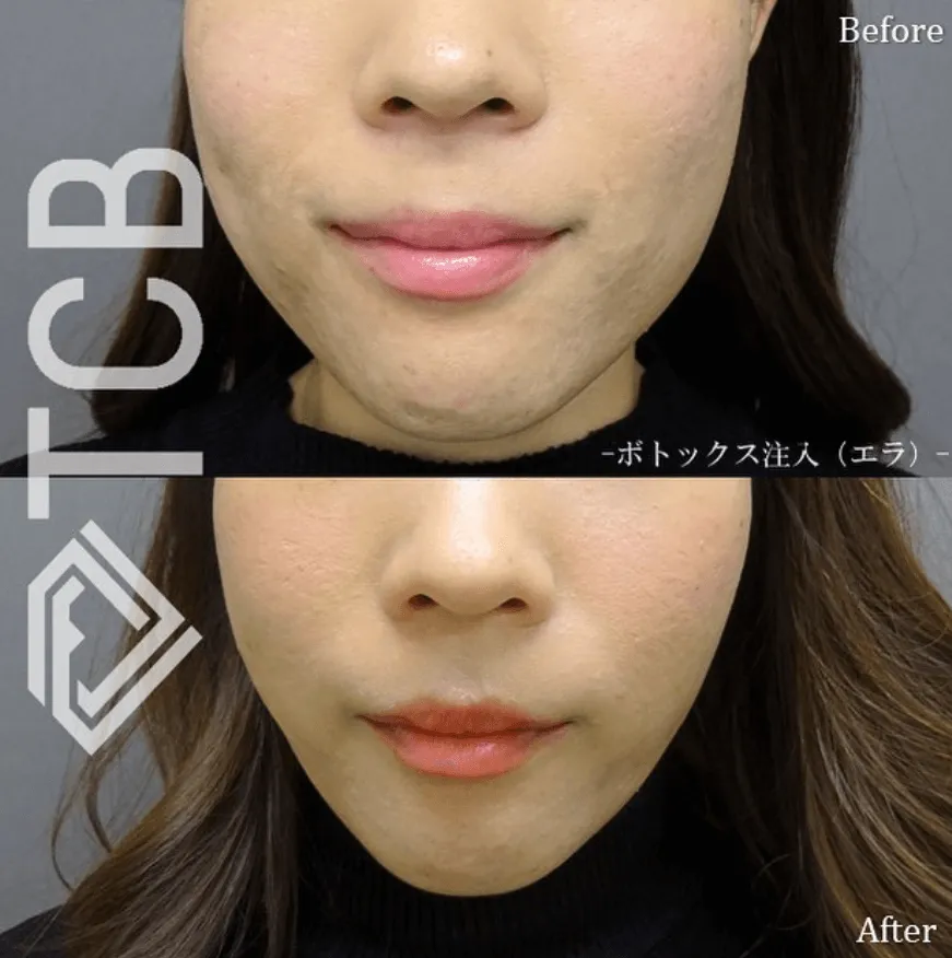東京中央美容外科エラボトックス症例写真
