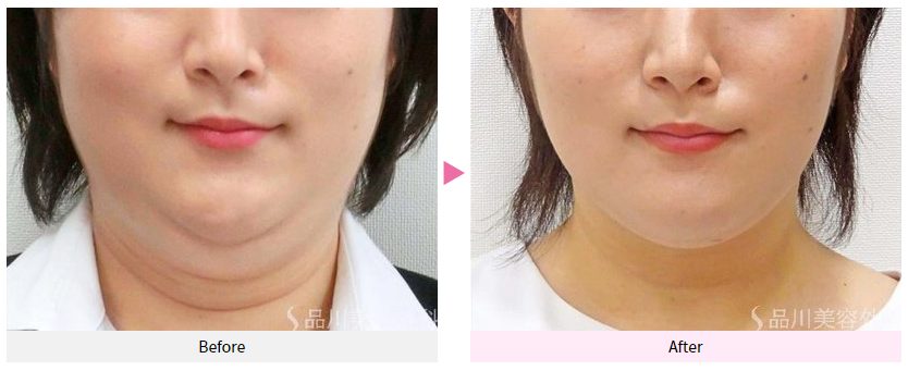 品川美容外科の脂肪溶解注射の顔症例